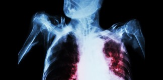Pulmonary Tuberculosis With Acute Respiratory Failure