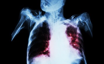 Pulmonary Tuberculosis With Acute Respiratory Failure