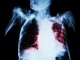 Pulmonary Tuberculosis With Acute Respiratory Failure